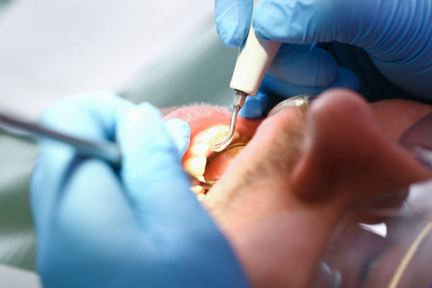 Best Emergency Root Canal Treatment in East Grand Rapids, MI